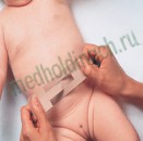 Порофикс для пупочных грыж